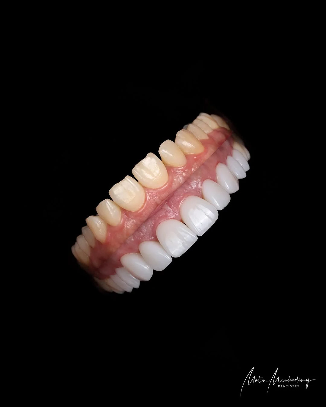 Simple veneer case — slide 1