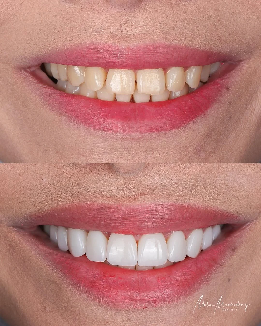 Simple veneer case — slide 2