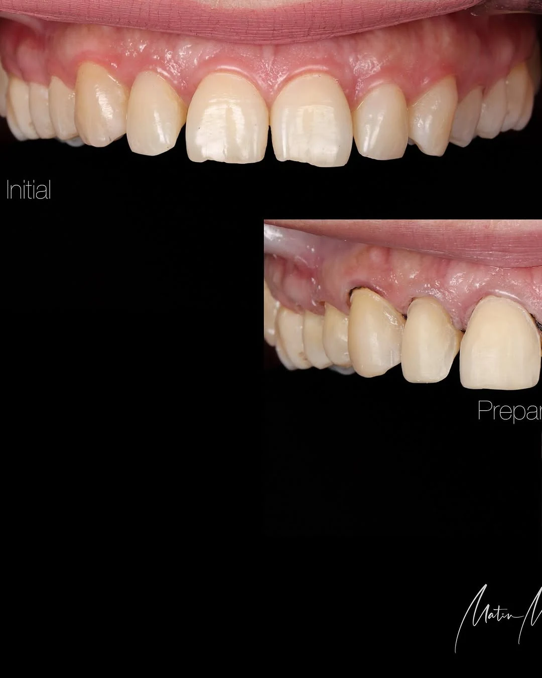 Simple veneer case — slide 3
