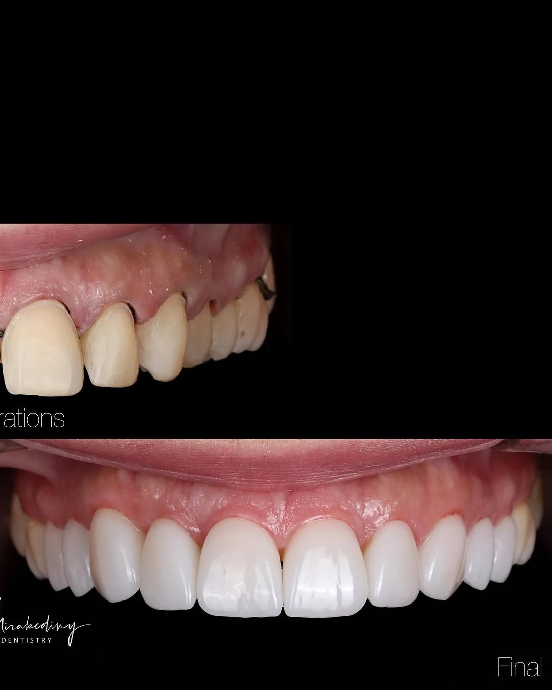 Simple veneer case — slide 4