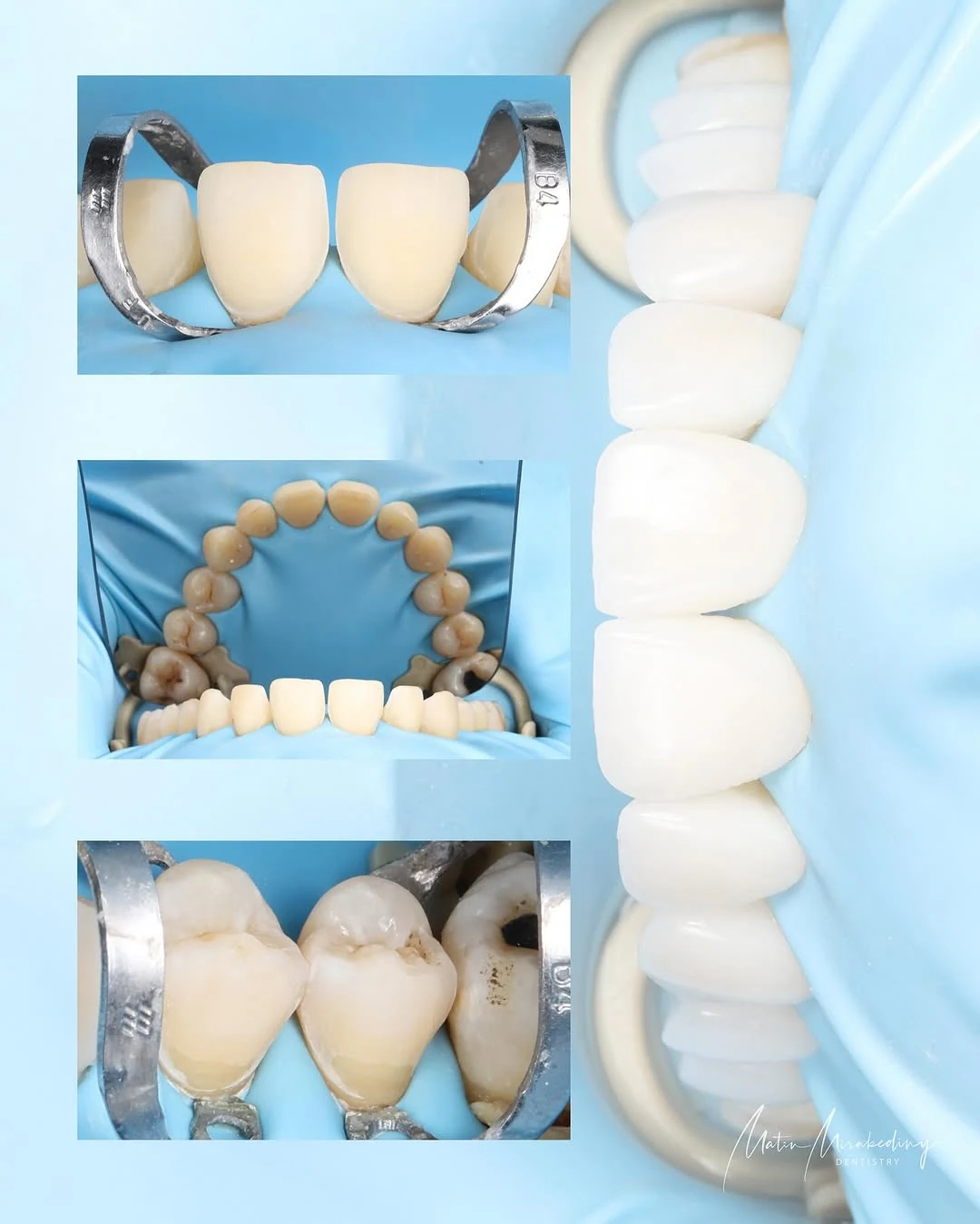 Simple veneer case — slide 5