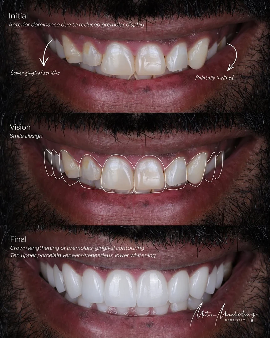Anterior balance — stage two
