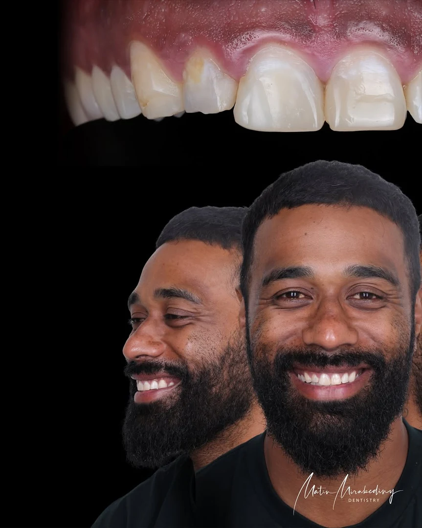 Anterior balance — stage three