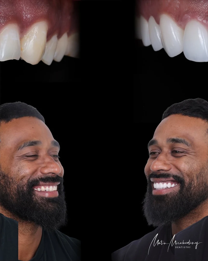 Anterior balance — stage four