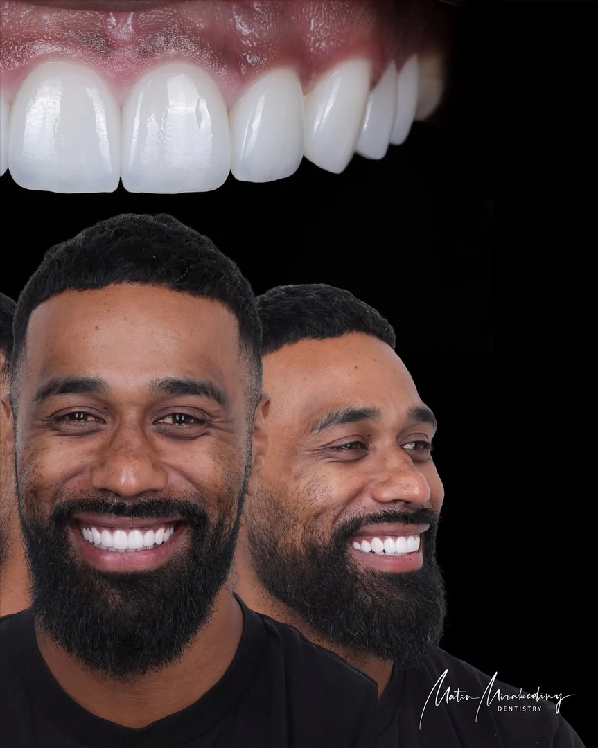 Anterior balance — stage five