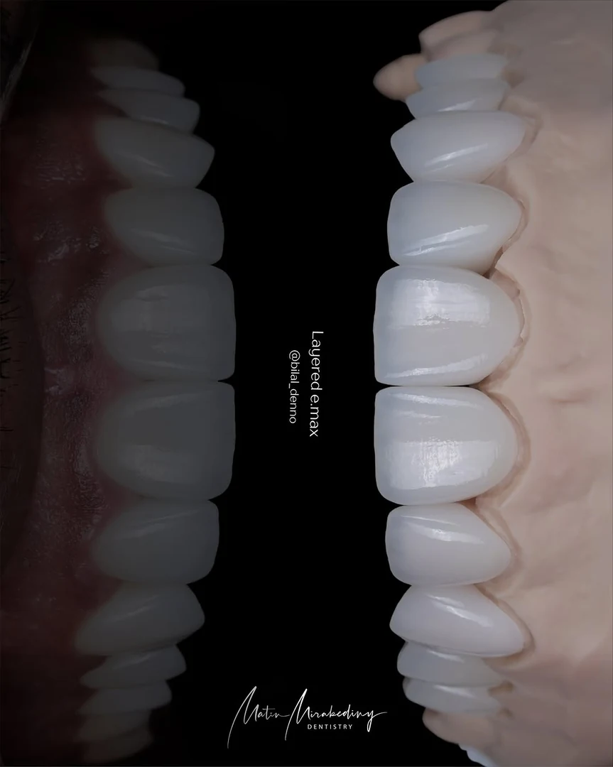 Anterior balance — final detail