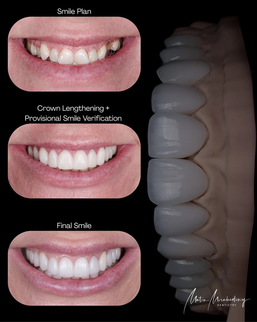 Pink and white case — treatment stage