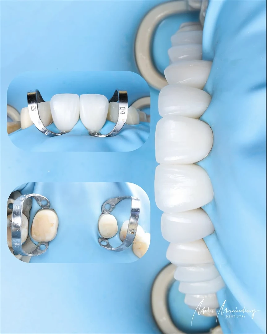 Pink and white case — treatment stage