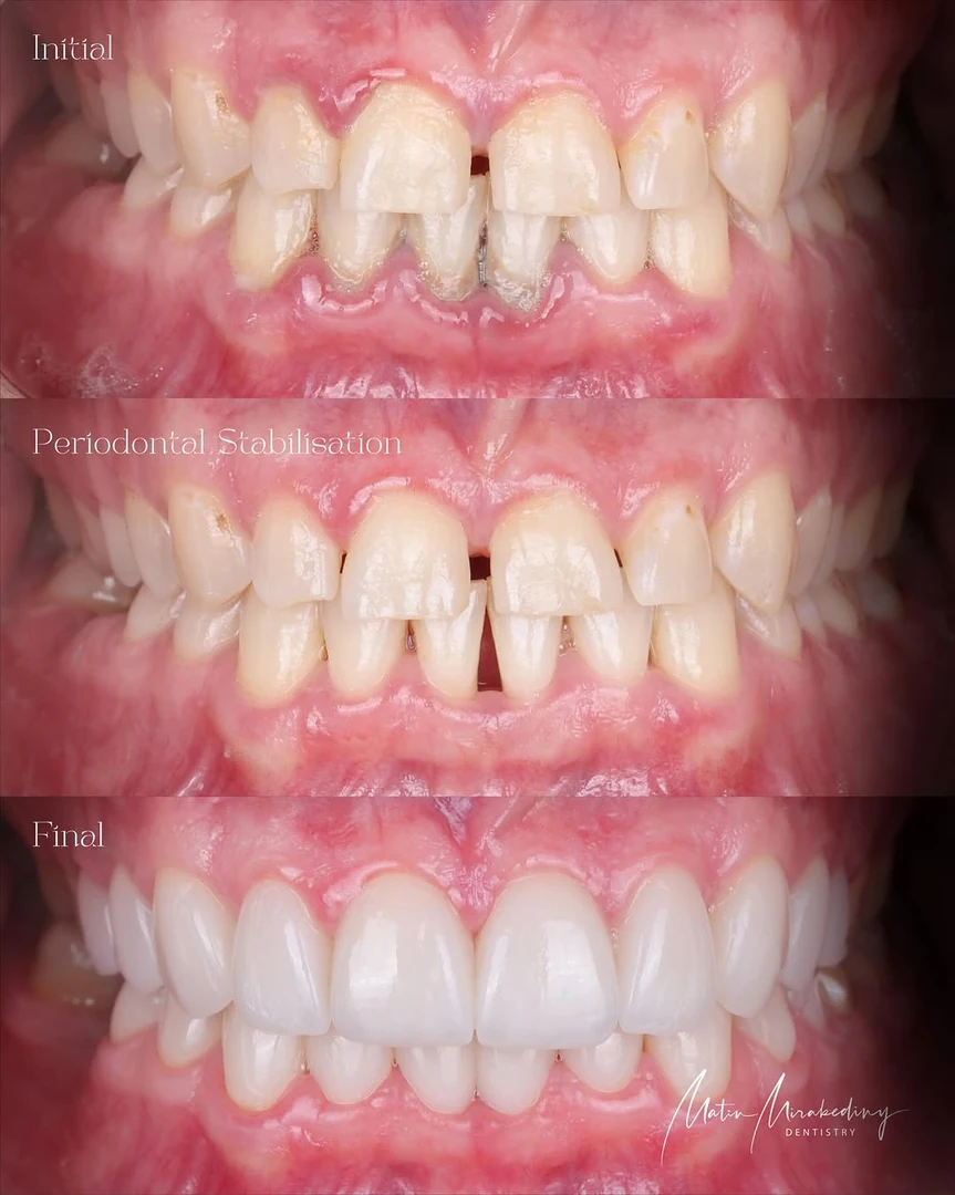 Restoration — stage two