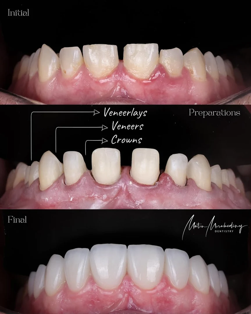 Restoration — stage three