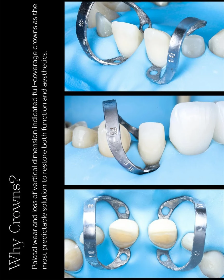 Restoration — stage four