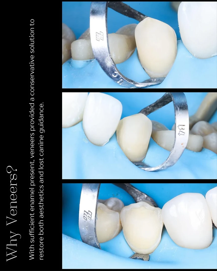 Restoration — stage five