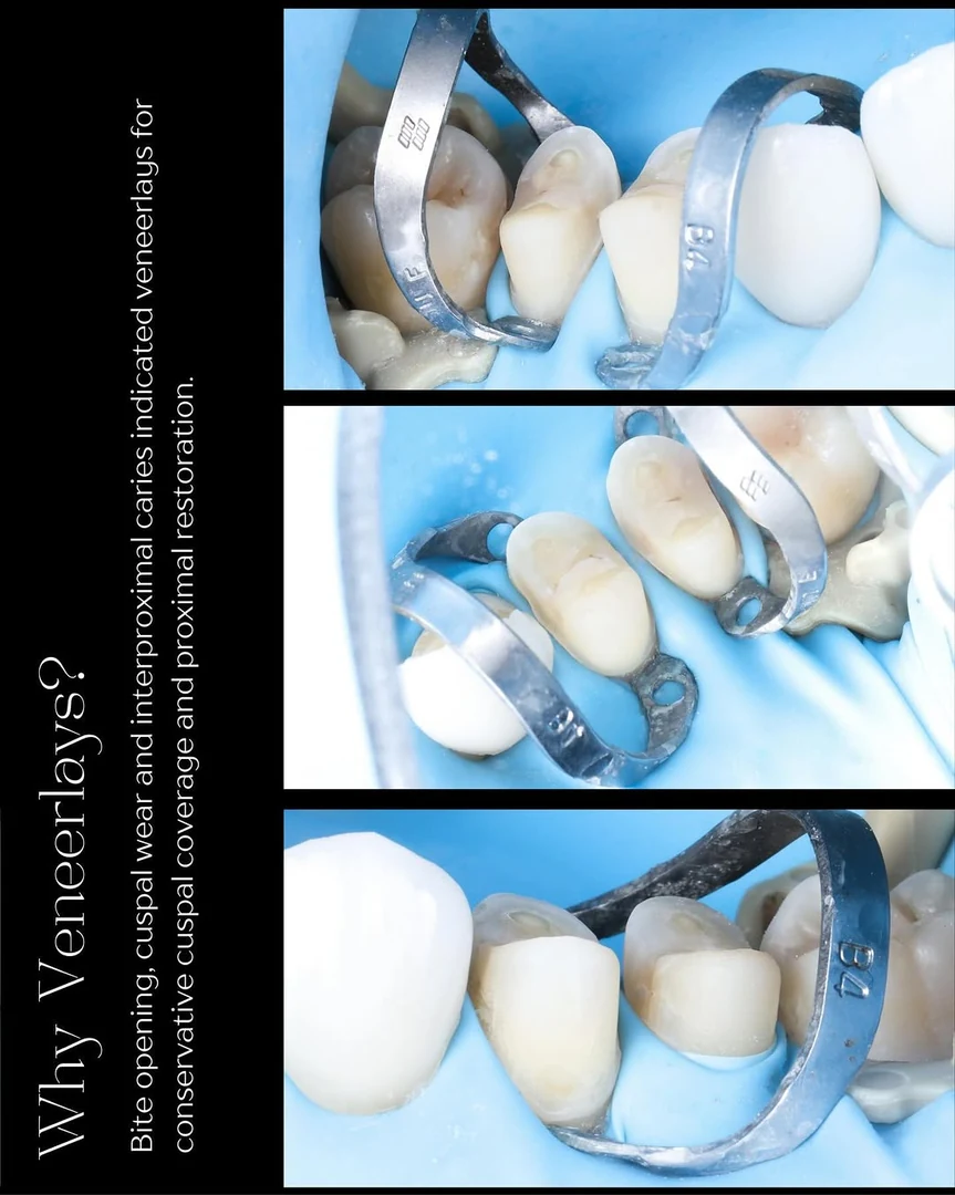 Restoration — stage six